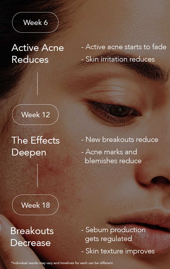 A 18 Weeks Journey to Clear, Smooth Skin
Month 1 - Active Acne Reduces, Active acne starts to fade, Skin irritation reduces
Month 2 - Effects Deepen, New breakouts reduce, Acne marks and blemishes reduce
Month 3 - Breakouts Decrease, Sebum production gets regulated, Skin texture improves
